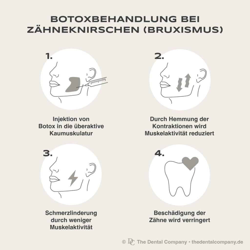 Botox gegen Zähneknirschen